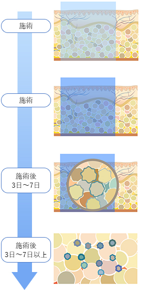 脂肪冷却